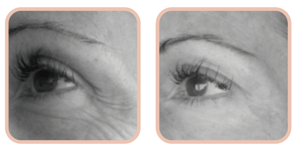 avant après cure jeunesse